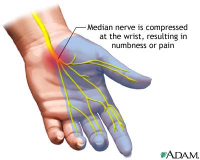 anatomy of the hand and pressure on the median nerve causes carpal tunnel