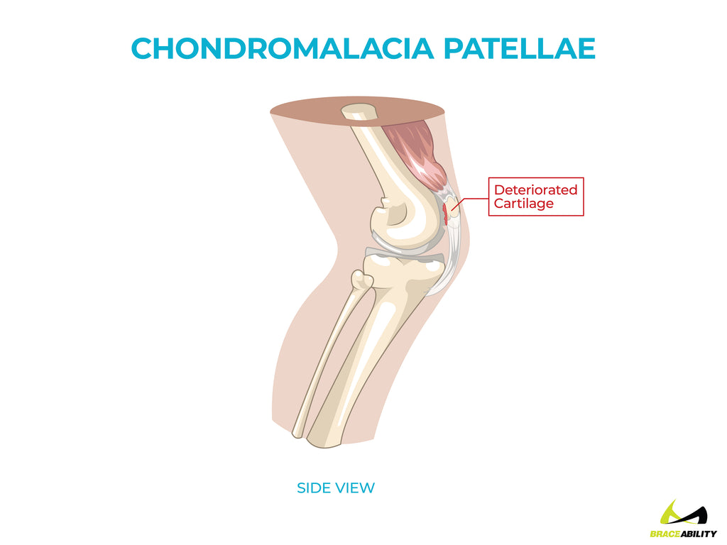 anatomy of chondromalacia patellae causing back of knee pain