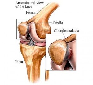 chondromalacia in the knee cap and patellofemoral from kneecap pain