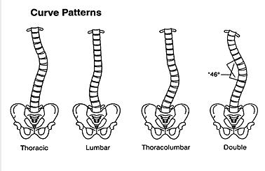 Curve patters from scoliosis and how a brace can help fix it
