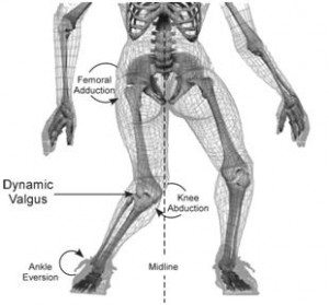 diagram of an ACL tear injury