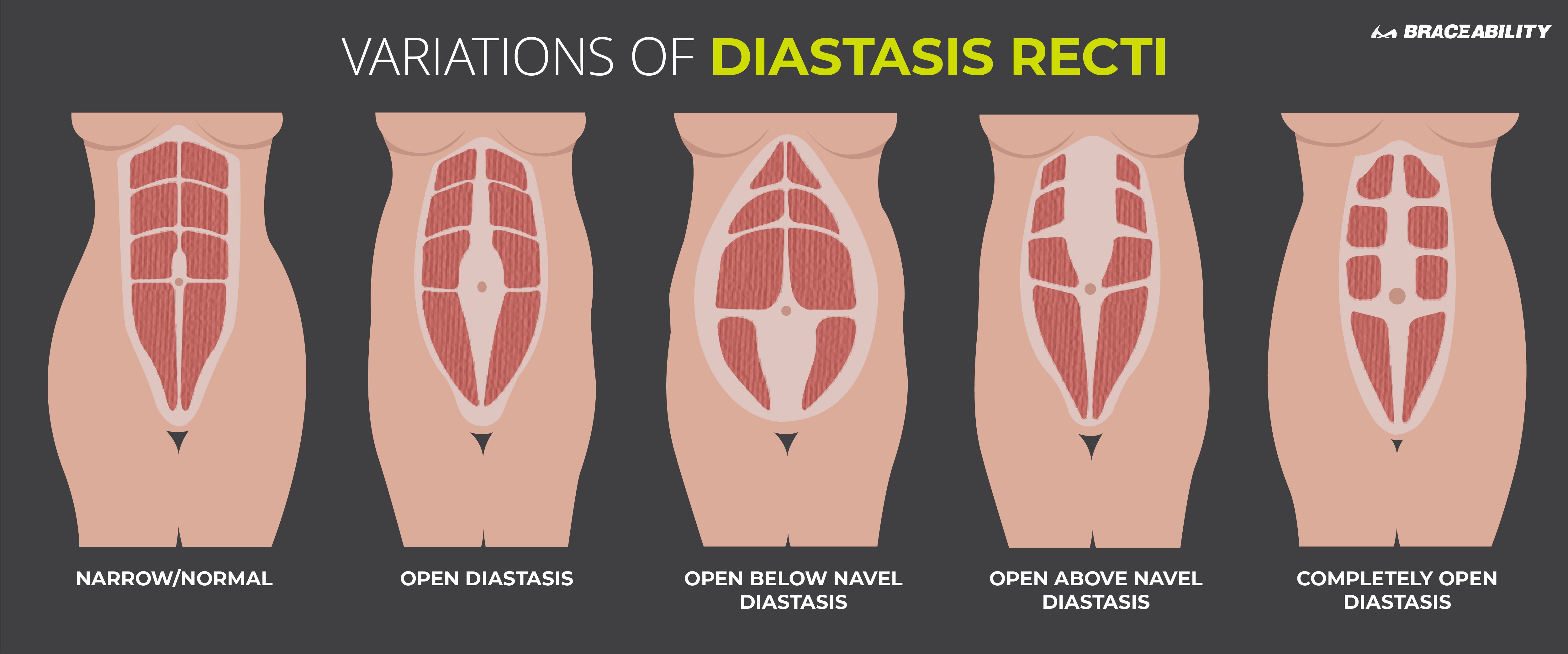 infografik som visar hur man ser om man har diastasis recti