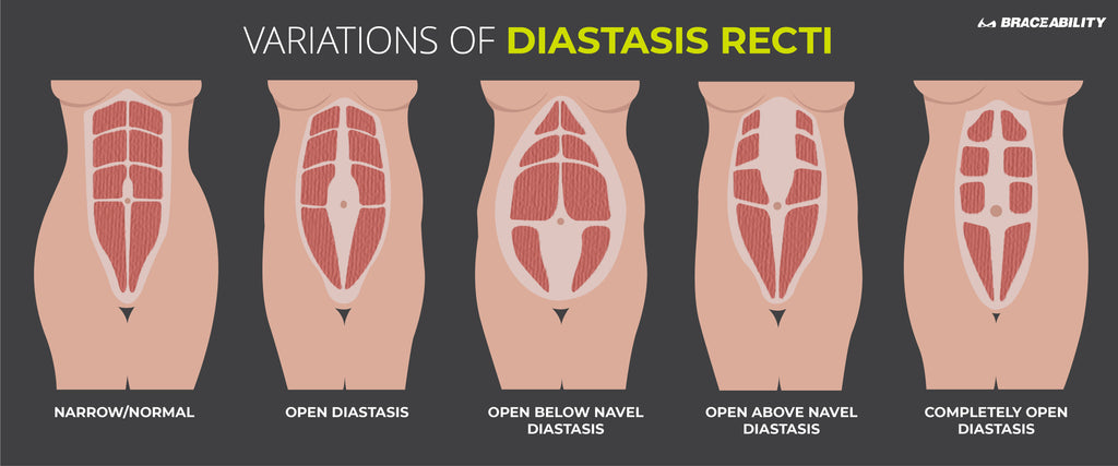 How To Check For Diastasis Recti