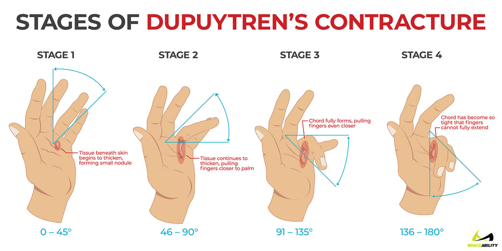 learn about the four stages of dupuytren's contracture 