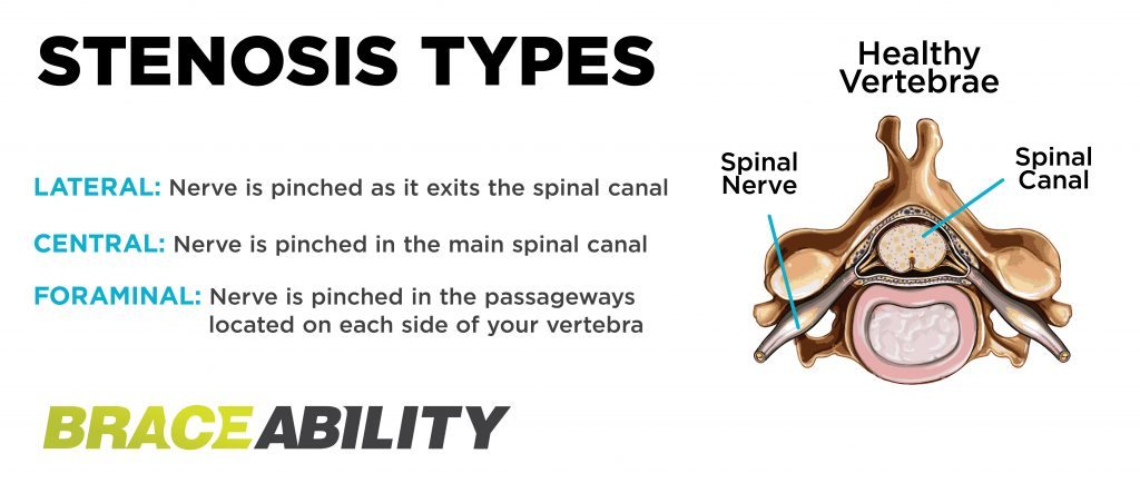 comparison of lateral, central and foraminal spinal stenosis and what part of the anatomy is effected