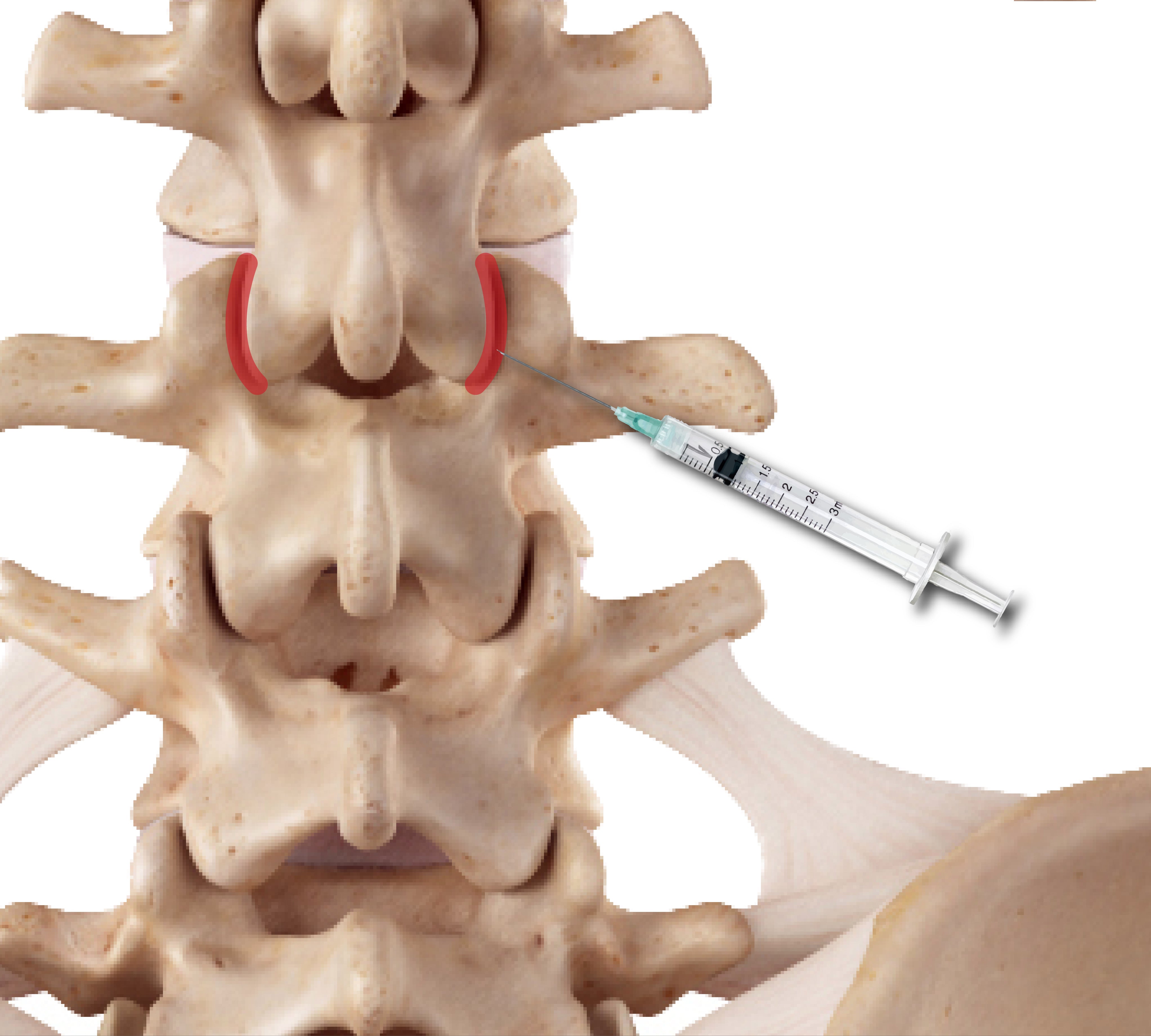 Facet syndrome treatment with injections to the joint