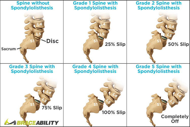 graphic of the different grades of spondylolisthesis and how far your disc has slipped