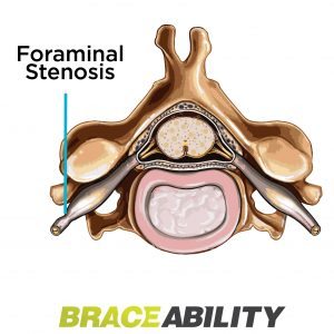 Foraminal spinal stenosis is a pinched nerve in the passageway of your vertebra