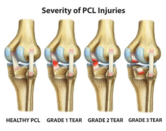 the different grades of pcl injuries in your knee and how the differ