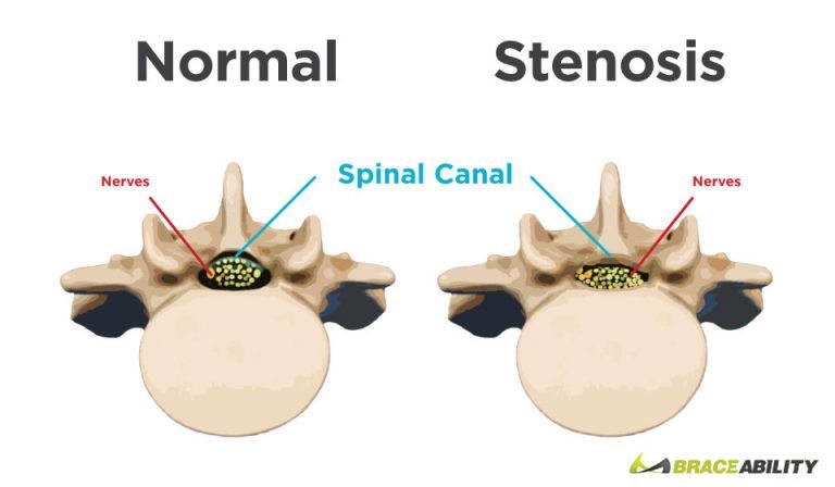 spinal stenosis in a vertebra vs a healthy spinal disc