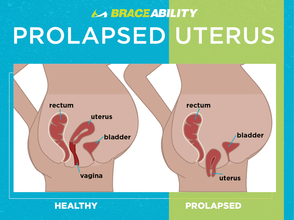 healthy uterus vs prolapsed uterus 