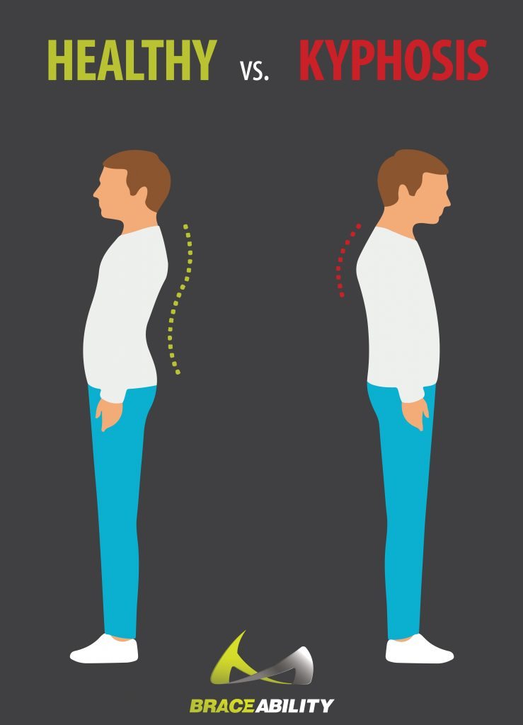 a healthy spine vs. a spine with a kyphosis spinal curve