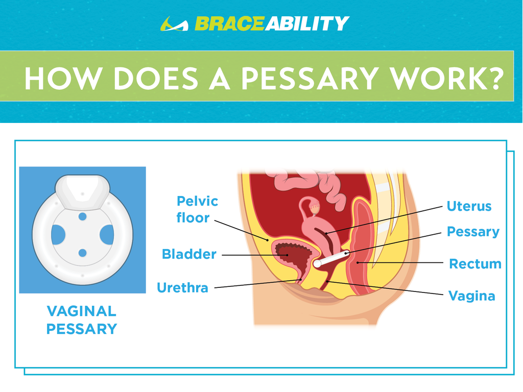 how does a pessary work