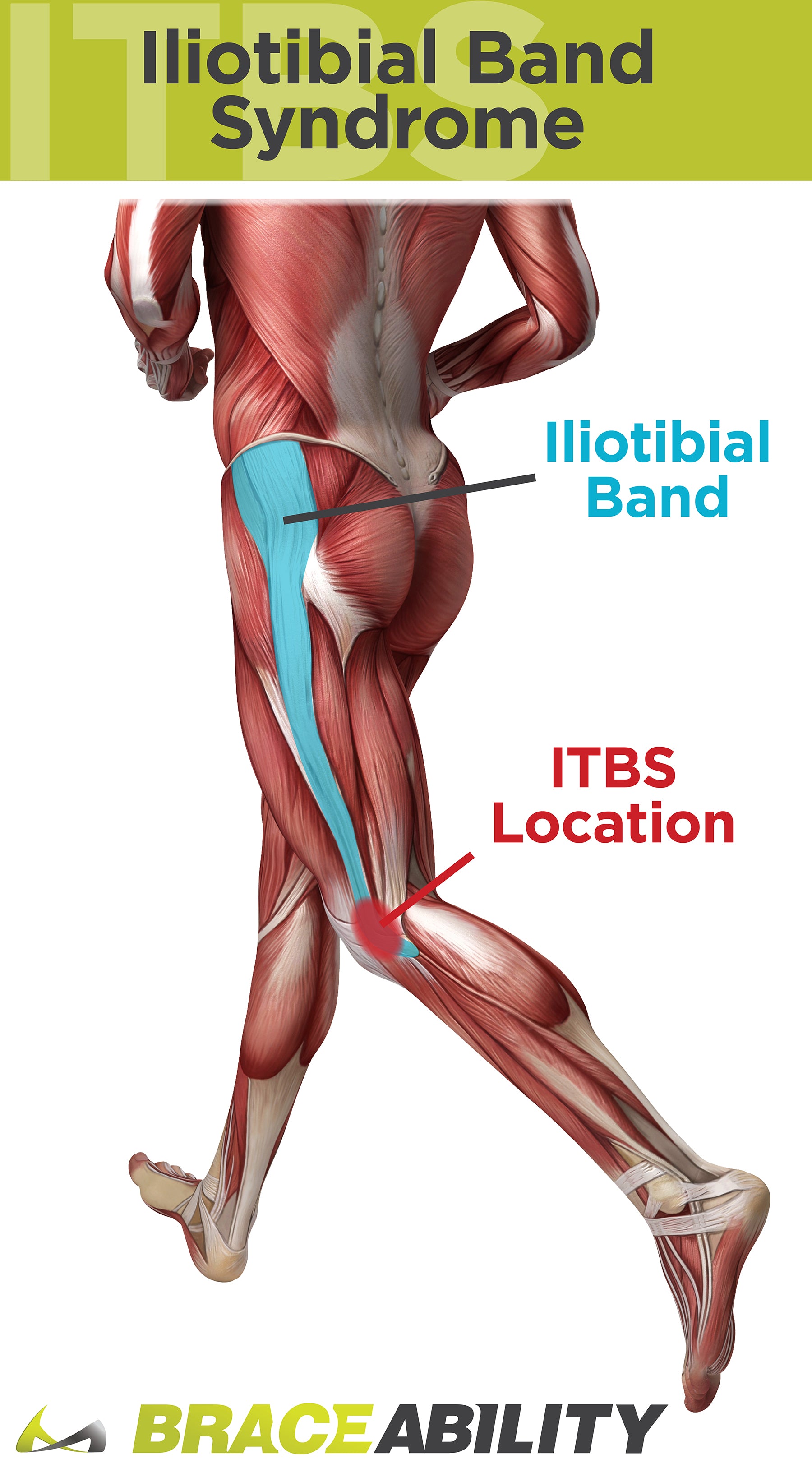 IT band syndrome is a leading cause of knee pain through the iliotibial band syndrome