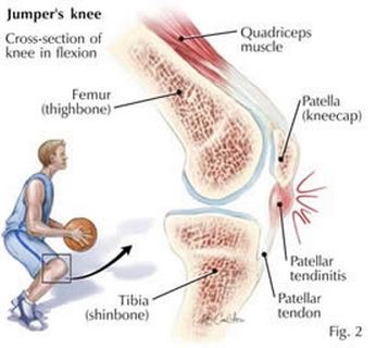 anatomy of jumper's knee, symptoms, possible causes, treatments, and prevention