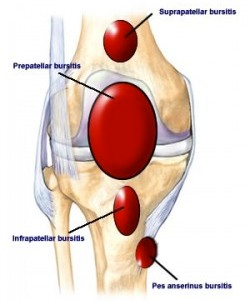 learn about knee bursitis anatomy, symptoms, and treatments