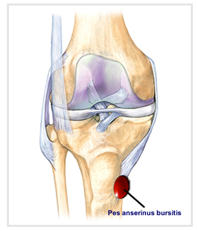 anatomy of the pes anserinus bursa, possible causes of injury, and treatment