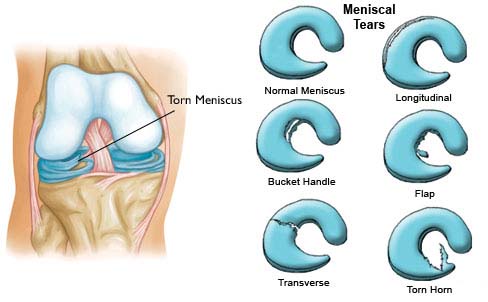 knee cartilage anatomy and possible meniscus injuries during contact sports