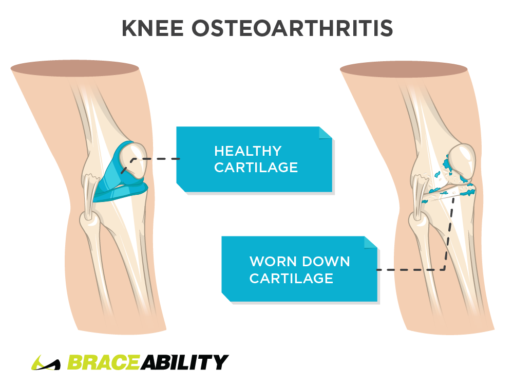 Pain inside the knee from knee osteoarthritis