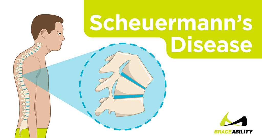 scheuermann's disease picture of spinal deformation