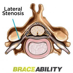 Lateral spinal stenosis is a pinched nerve where it exits the spinal canal