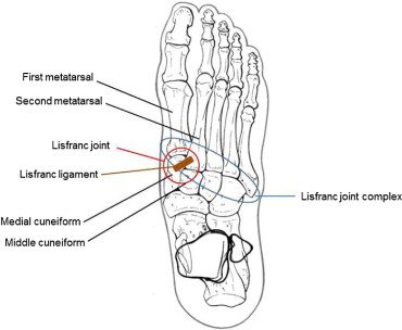 lisfranc foot injury location with anatomy labeled