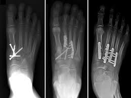 severe lisfranc injuries can require surgery to realign the joint 