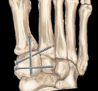 Lisfranc surgical treatment usually involves the insertion of screws into the foot and toe bones