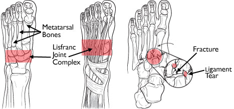 more severe lisfranc foot injuries include fractures, ligament tears, and dislocated bones