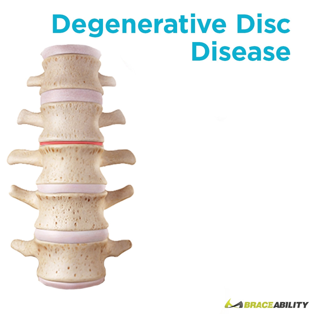 Treating degenerative disc disease with an LSO back support