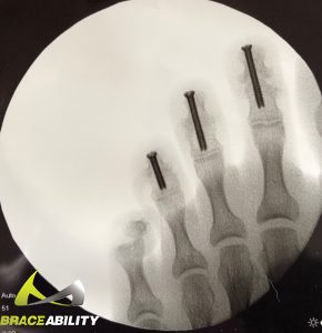 screws in toes to help heal toes after mallet toe surgery