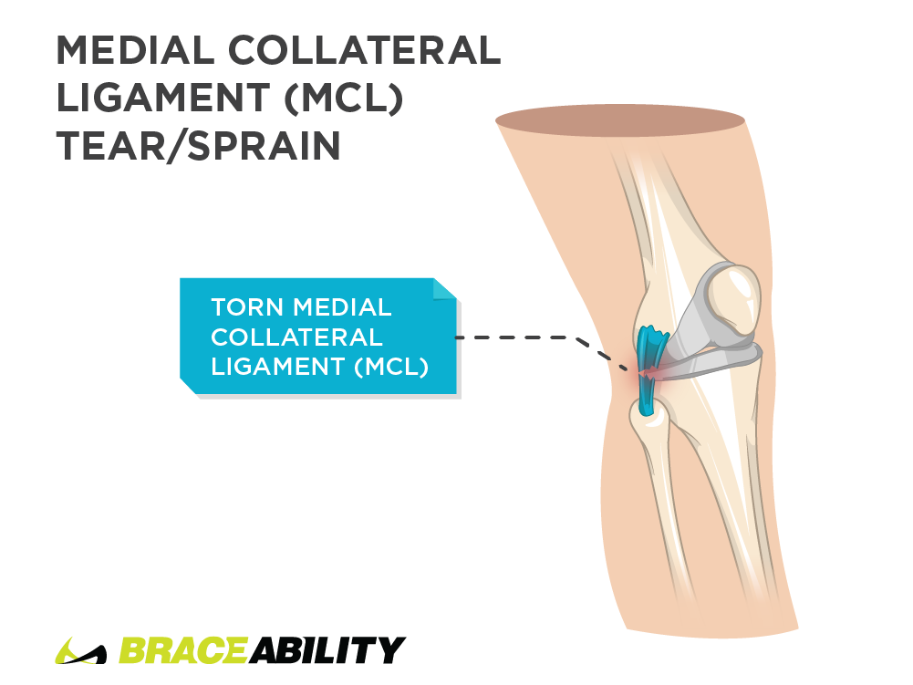 pain inside of the knee from medial collateral ligament tear or sprain
