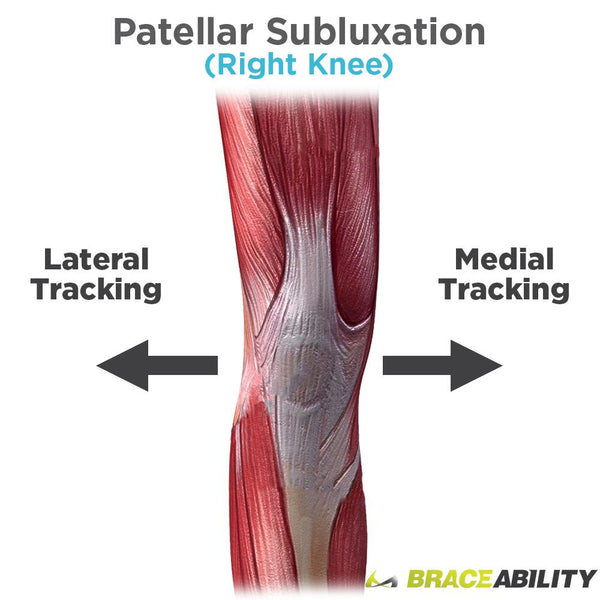 lateral patellar subluxation