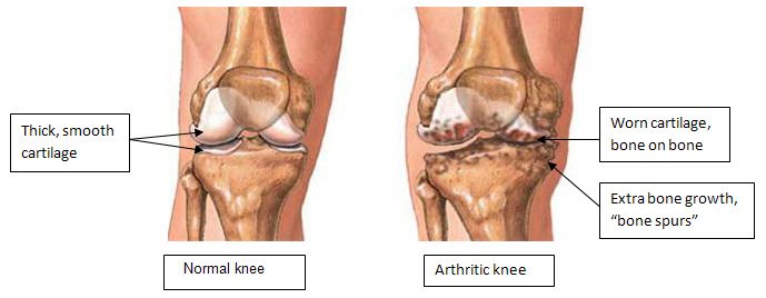 Chart comparing arthritis of the knee with degenerated joints vs. a healthy kneecap