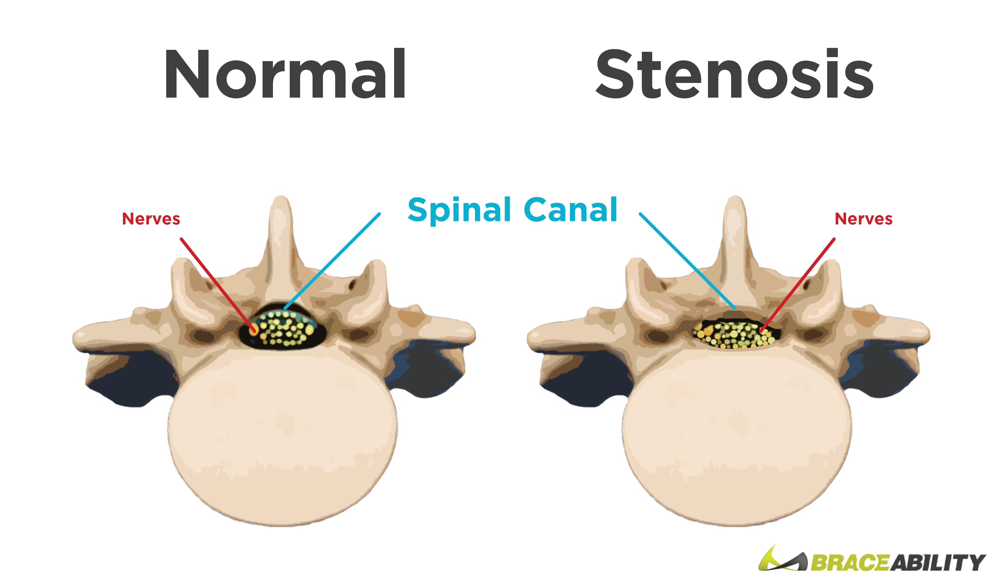 Spinal Stenosis  What Causes Narrowing of your Spine or Backbone?