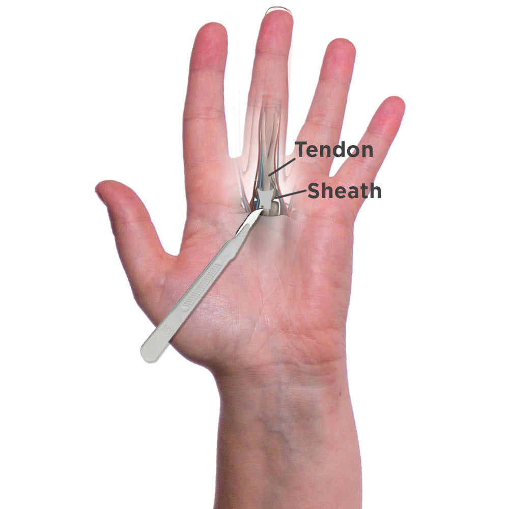  open surgery for trigger finger or thumb pain