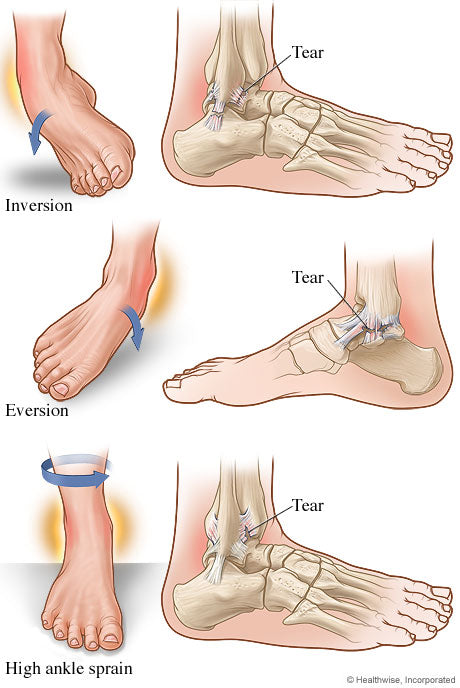 Using an ankle brace from BraceAbility will help fix foot and ankle problems