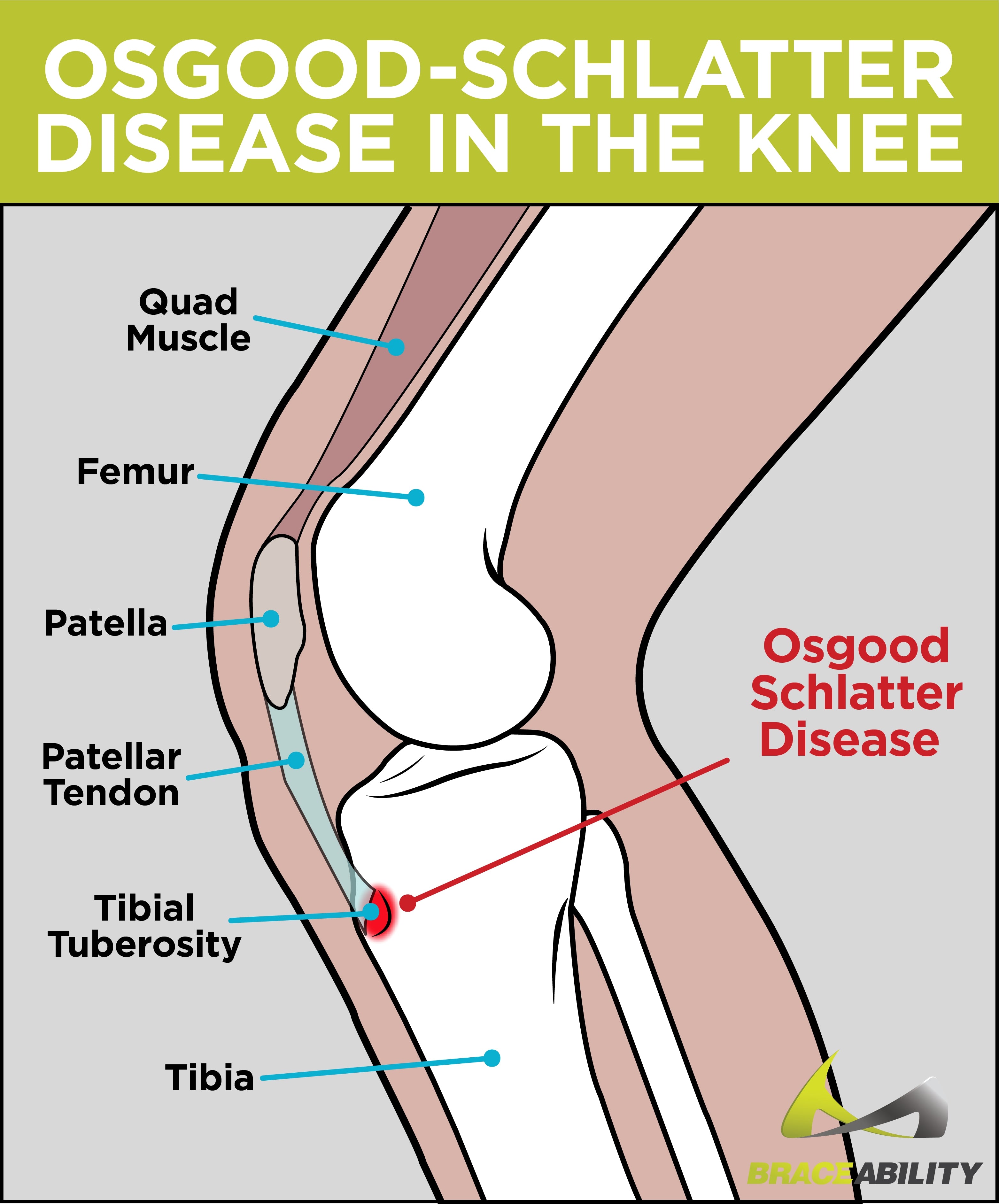 what osgood-schlatters looks like in children with anatomy graphic