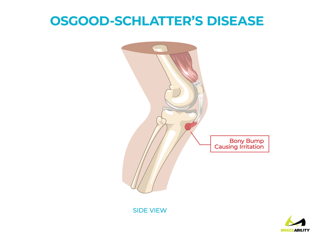 anatomy of osgood schlatter's disease causing back of knee pain