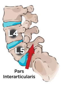 how a broken pars interarticularis can cause defects like spondylolisthesis