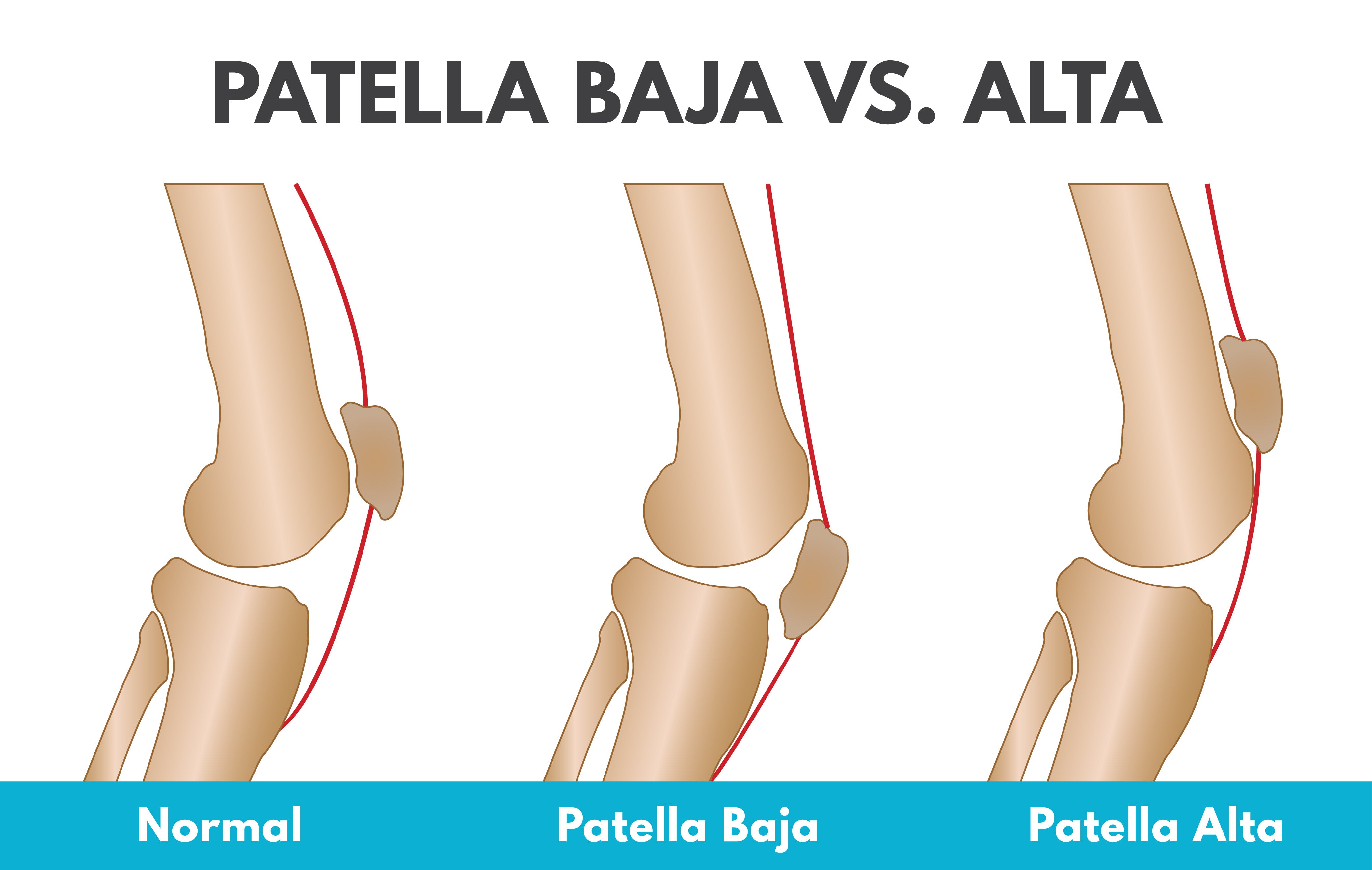 the difference between patella baja vs alta in your kneecap