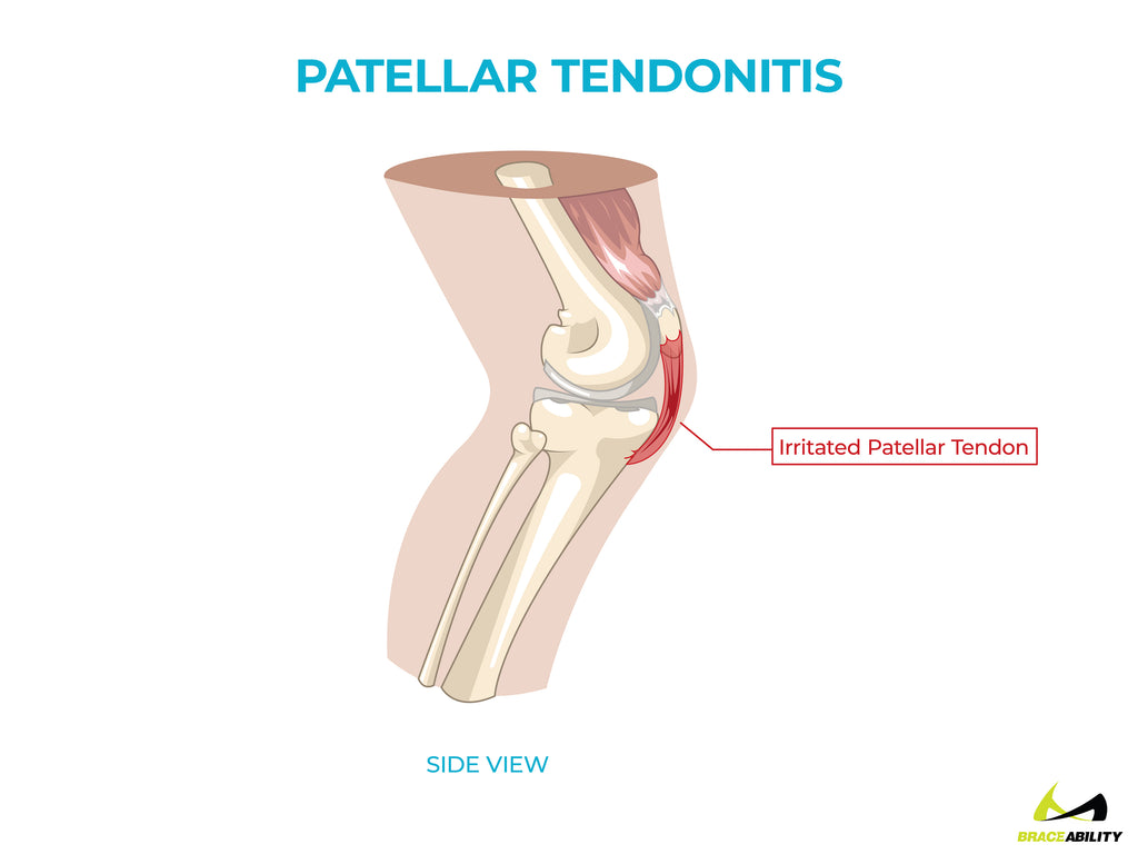 anatomy of patellar tendonitis causing back of knee pain