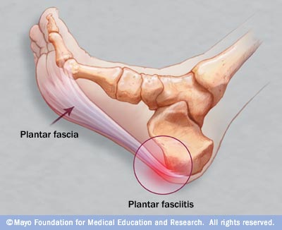 learn about foot anatomy, the plantar fascia, and causes of plantar fasciitis