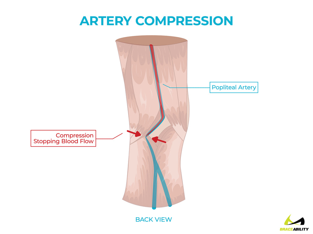 anatomy of compression on the popliteal artery causing back of knee pain