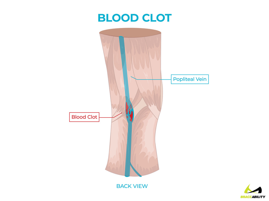 anatomy of a blood clot in the popliteal vein causing knee pain