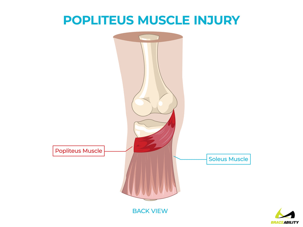 anatomy of a popliteus muscle injury and pain behind the knee