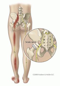Sciatica from a pinched nerve or herniated disc in the lower back