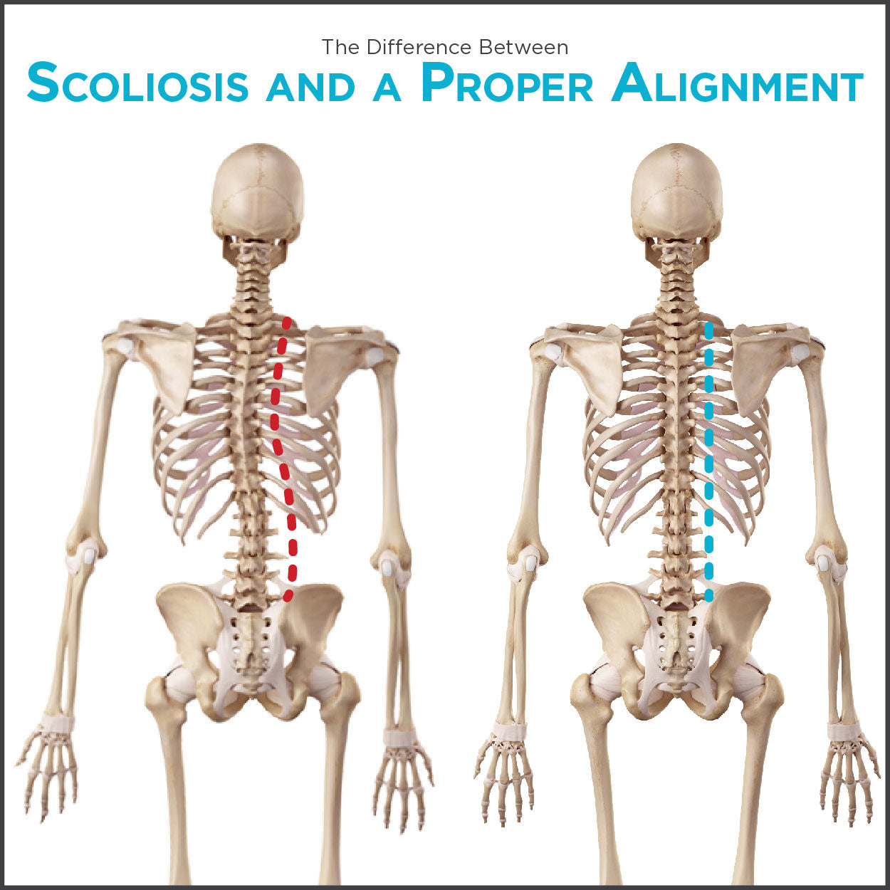 comparison chart of what scoliosis looks like vs how a healthy spine looks