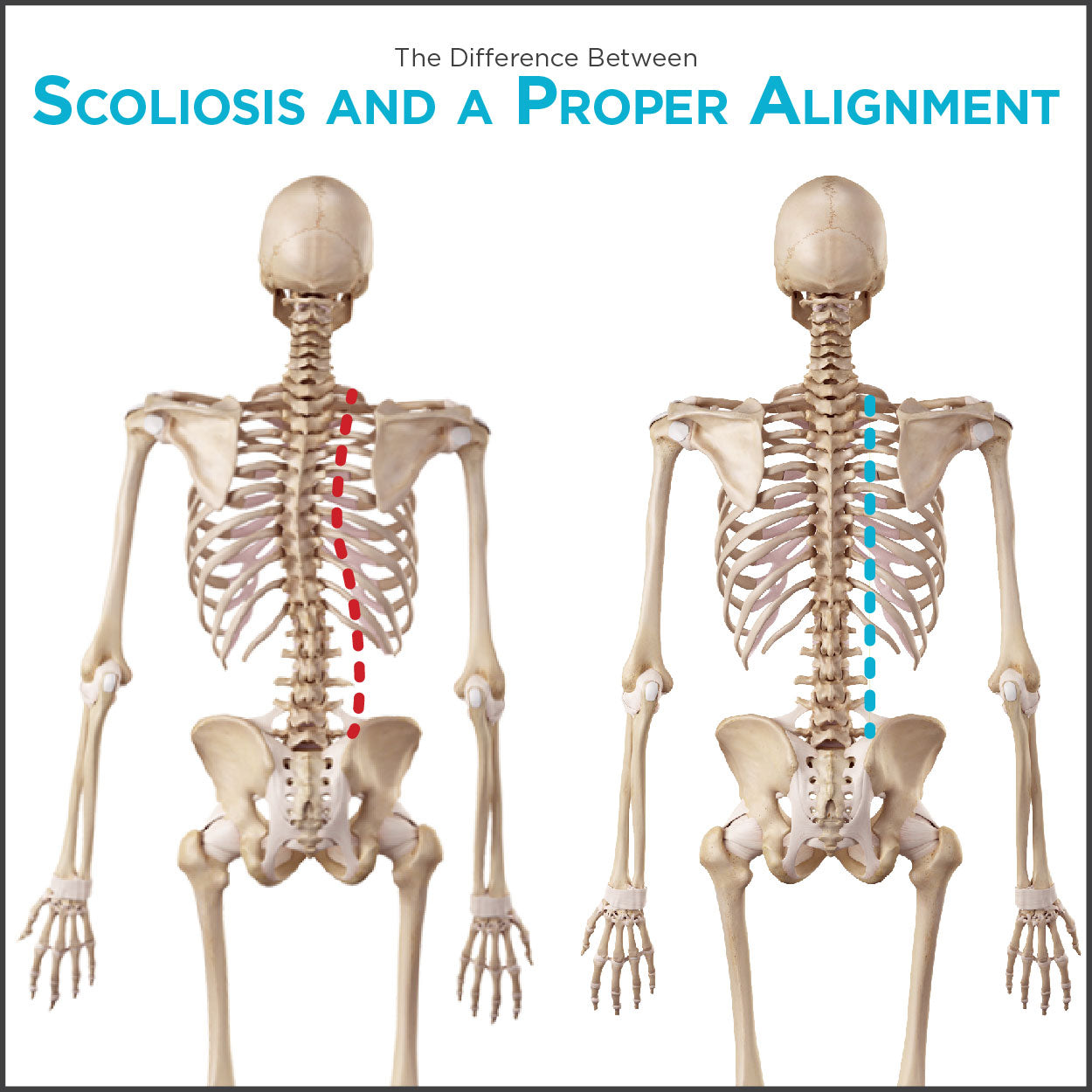 scoliosis types