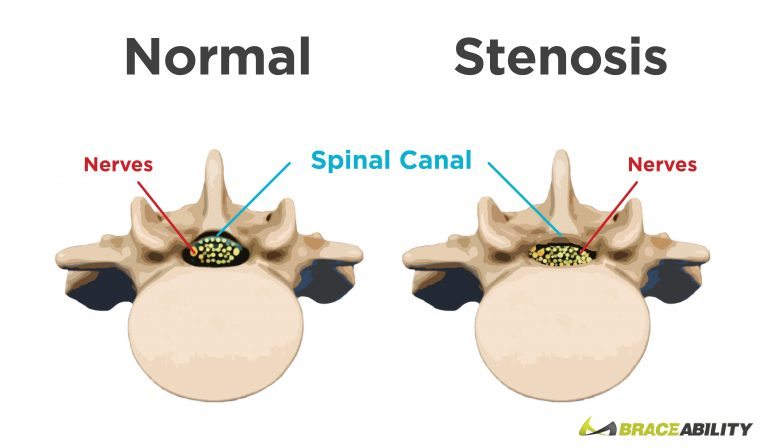comparison between a vertebra with spinal stenosis and a healthy disc